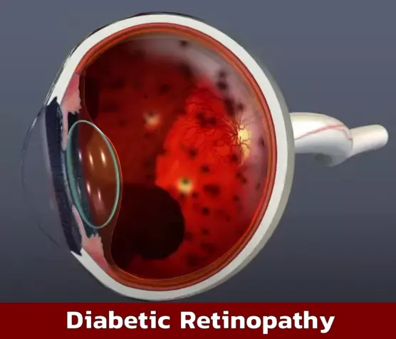 Diabetic Retinopathy