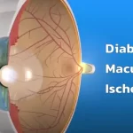 Diabetic Macular Ischemia