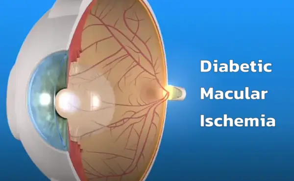 Diabetic Macular Ischemia