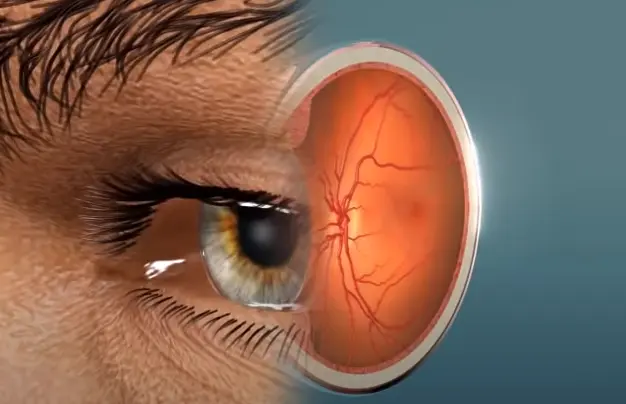 Signs of Retinal Damage