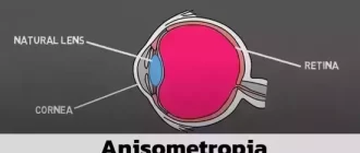 Anisometropia
