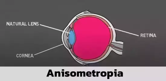 Anisometropia