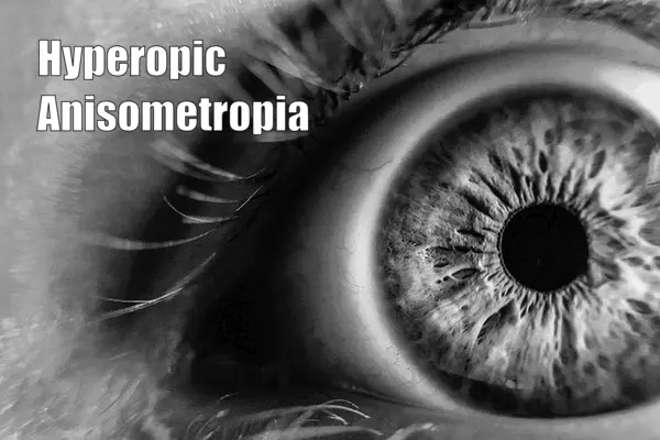 Hyperopic Anisometropia