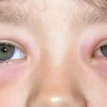 Swollen eyes in a child showing redness and puffiness around the eyelids.
