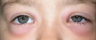 Swollen eyes in a child showing redness and puffiness around the eyelids.