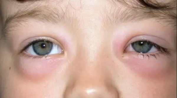 Swollen eyes in a child showing redness and puffiness around the eyelids.