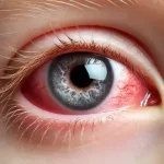 Child’s Eye Always Red and Irritated